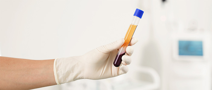 Traitement PRP - Dr J.LIU